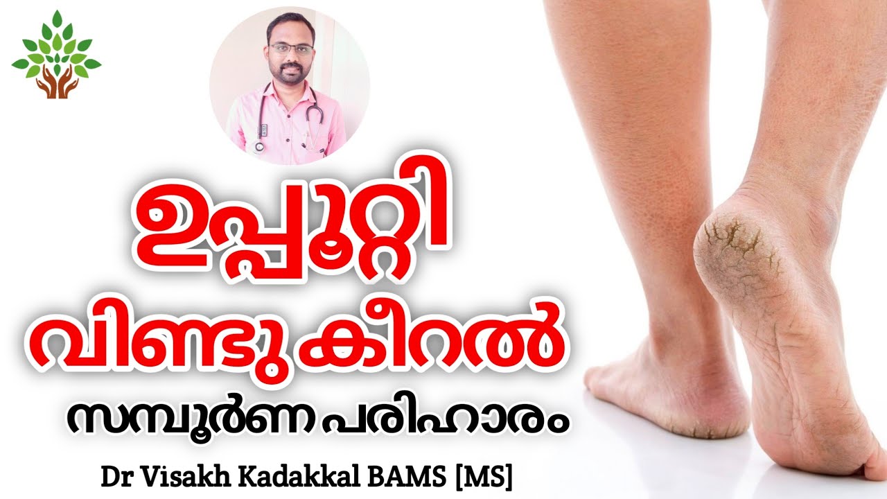 ഉപ്പൂറ്റി വിണ്ടുകീറൽ സമ്പൂർണ പരിഹാരം | Home Remedy for Cracked heels | Dr Visakh Kadakkal