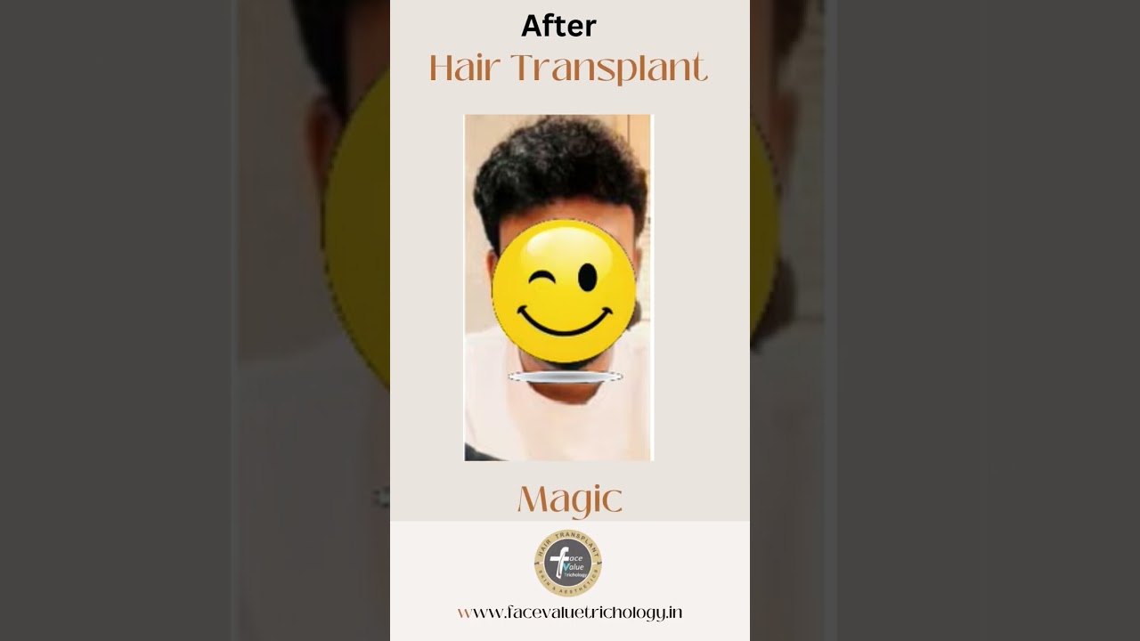Hair Transplant | DHI Method | Facevalue Trichology