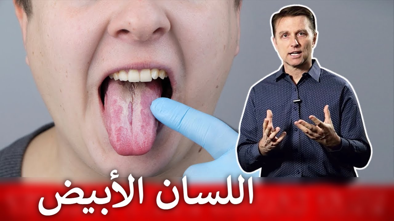 اللسان الأبيض | داء المبيضات الكانديدا