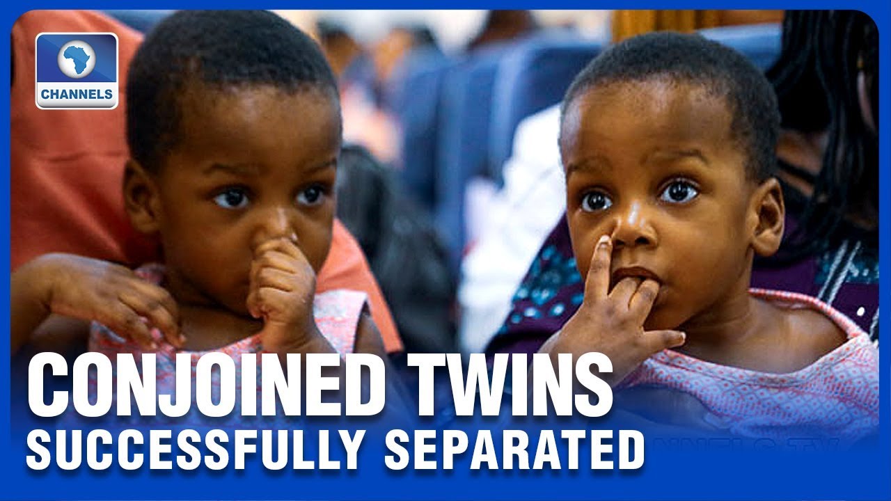 How A Nigerian Medical Team Successfully Separated Conjoined Twins
