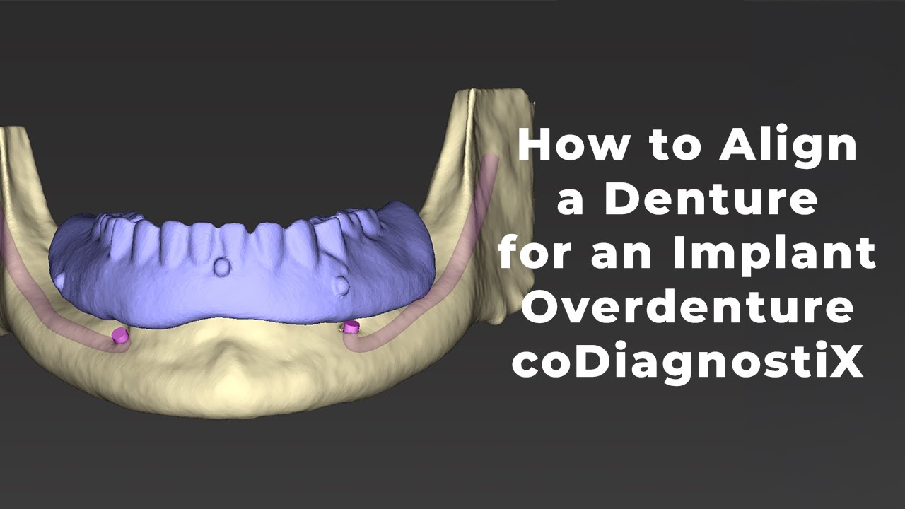 Aligning a Denture to CBCT for Implant Overdenture Planning | coDiagnostiX Workflow
