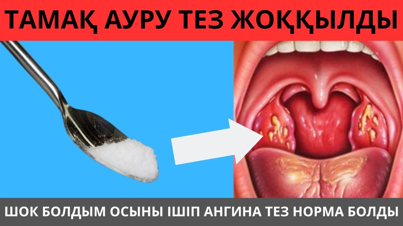 1 ҚАСЫҚ ТАМАҚ АУРУЫН ТЕЗ ЖОҚ ҚЫЛДЫ. ОСЫДАН СОҢ ТАМАҚ АУРУЫН ҰМЫТТЫМ. тамақ ауырғанда не істеу керек