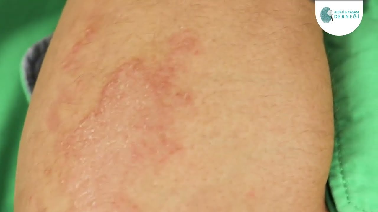 Atopik dermatit hastaları şiddetli kaşıntı için nasıl önlemler alabilirler?