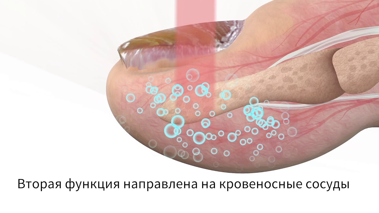 ERCHONIA LUNULA LASERS ANIMATION RUSSIAN