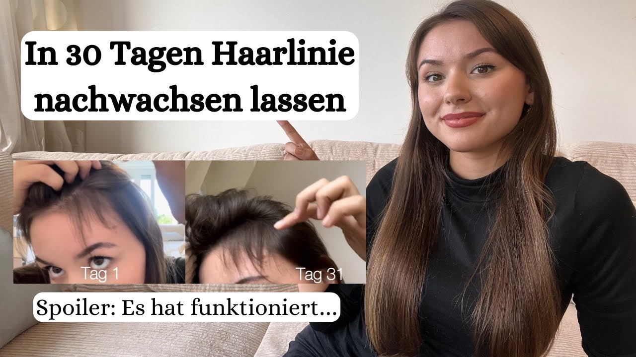 In 30 Tagen Haaransatz und Geheimratsecken nachwachsen lassen. Hat es funktioniert?