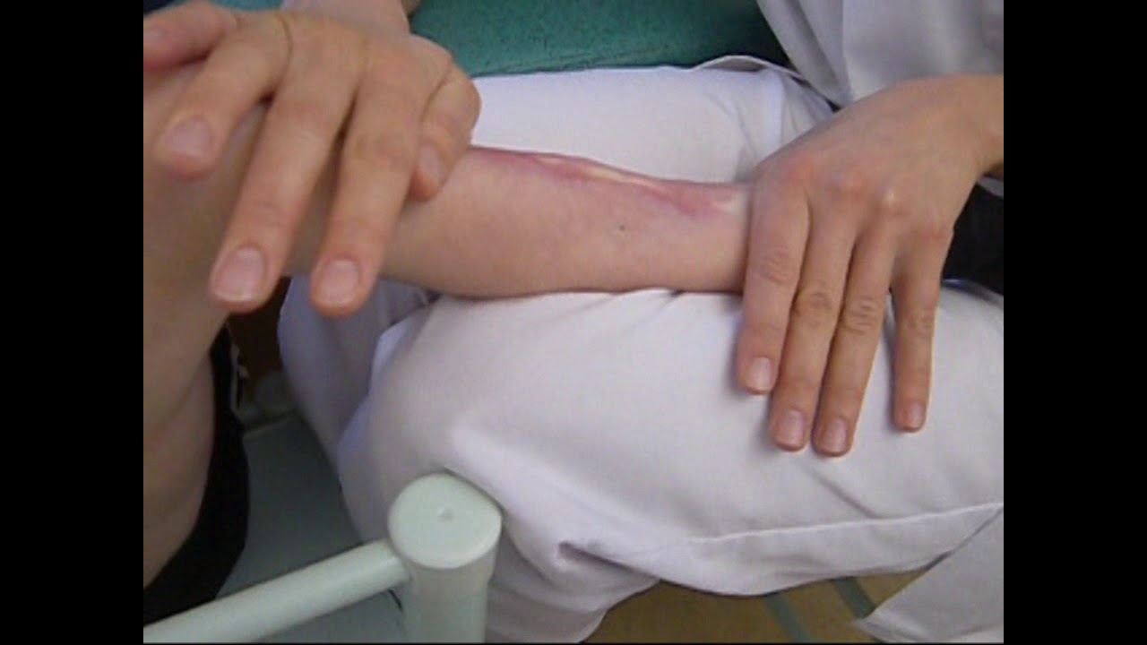Notions indispensables pour la kinésithérapie des patients présentant des séquelles de brûlures