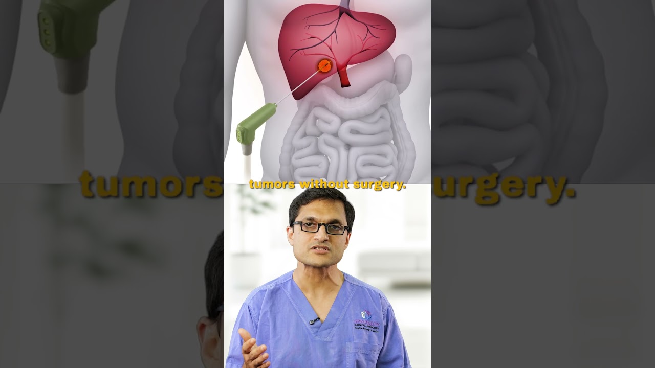 Liver Cancer Treatment &mdash; Explained Simply. #livercancer #livercancertreatment #cancer #cancercare