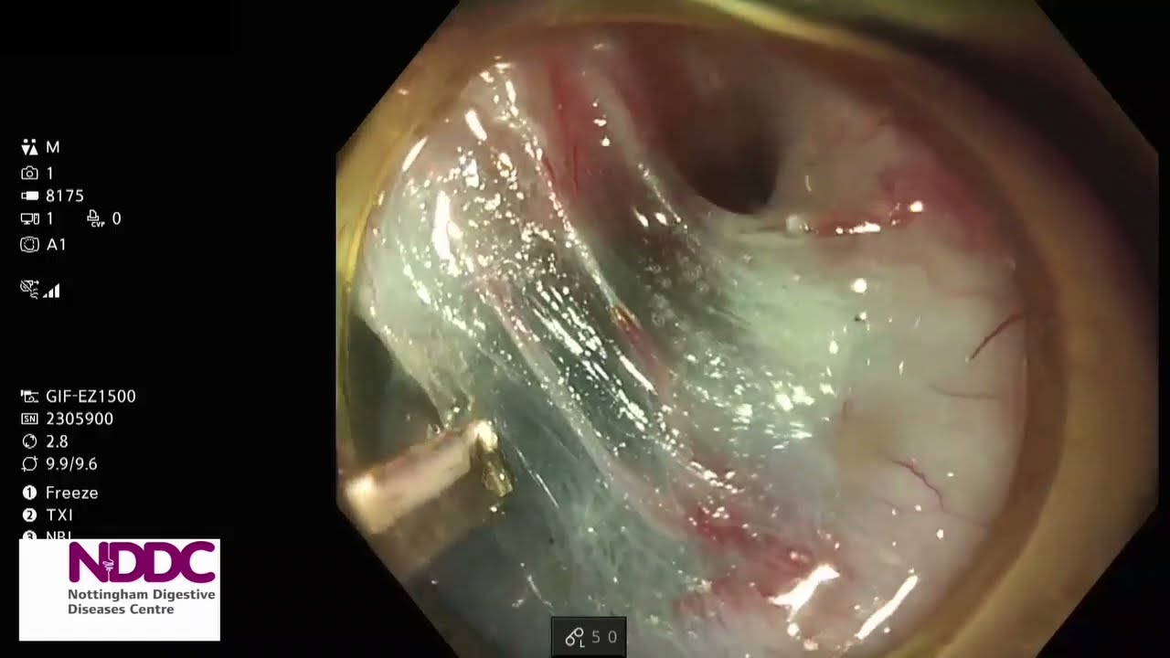 Oesophageal ESD - 90% Circumferential Approach  - Speedboat Notch - Dr Parra-Blanco (UK)