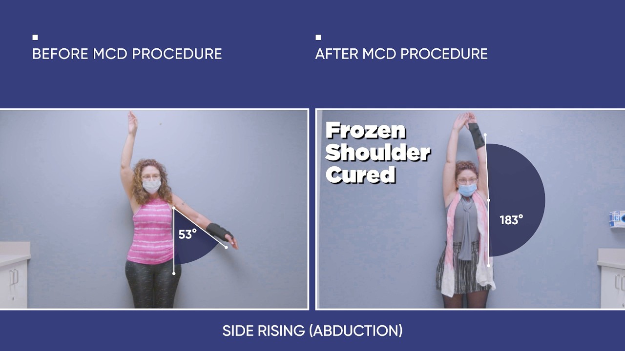 From Severe Frozen Shoulder Pain to Movement — Jeannie’s 2-Day Outcome