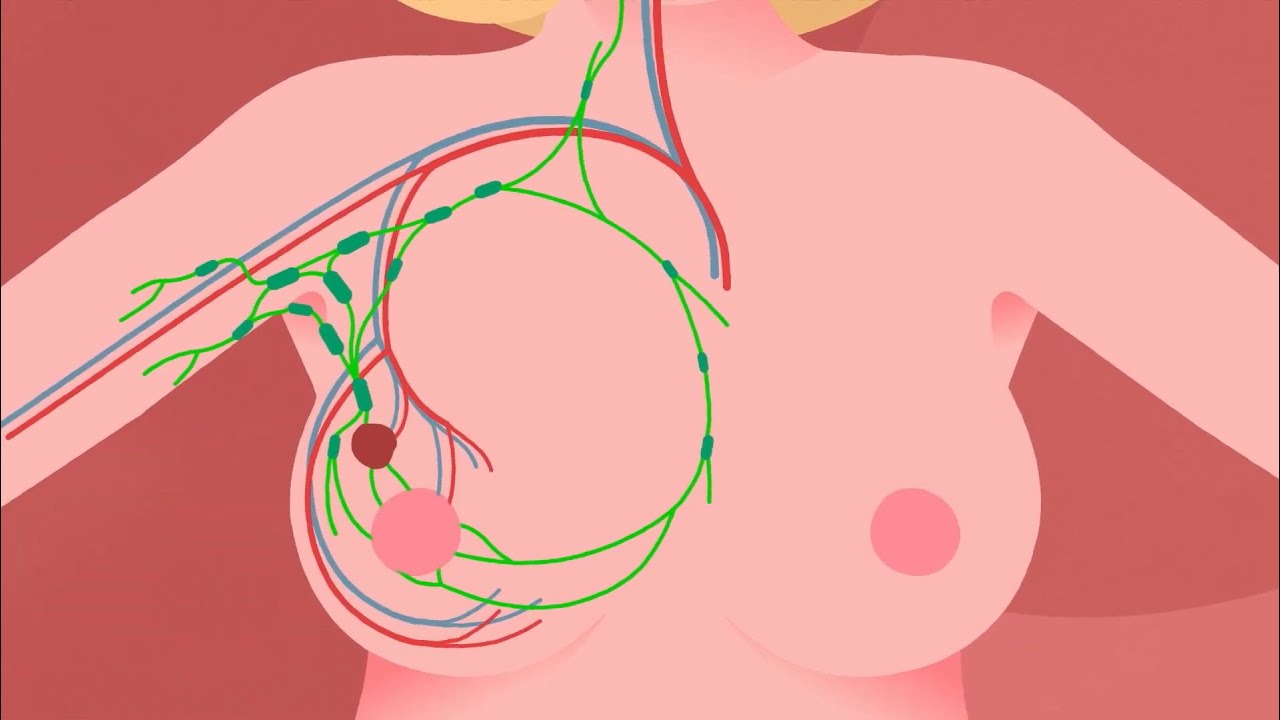 Informazioni, supporto e consulenza sul cancro al seno