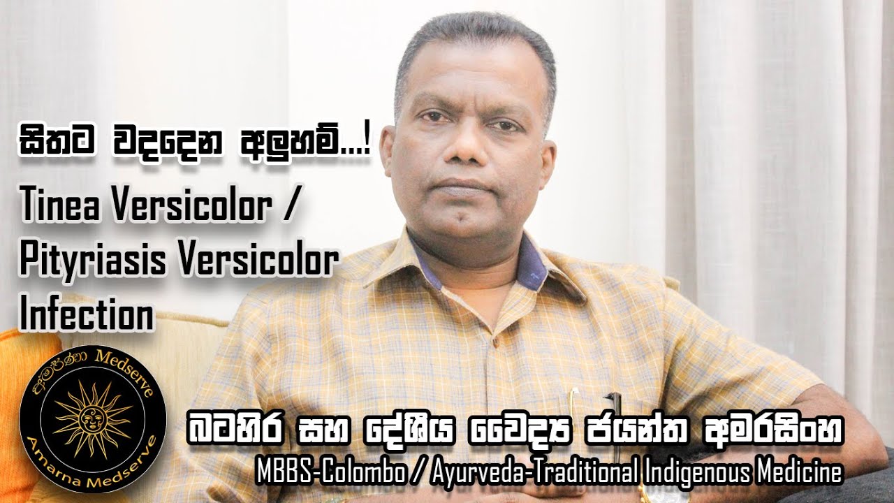 සිතට වදදෙන අලුහම්…! | Tinea Versicolor /Pityriasis Versicolor Infection...!
