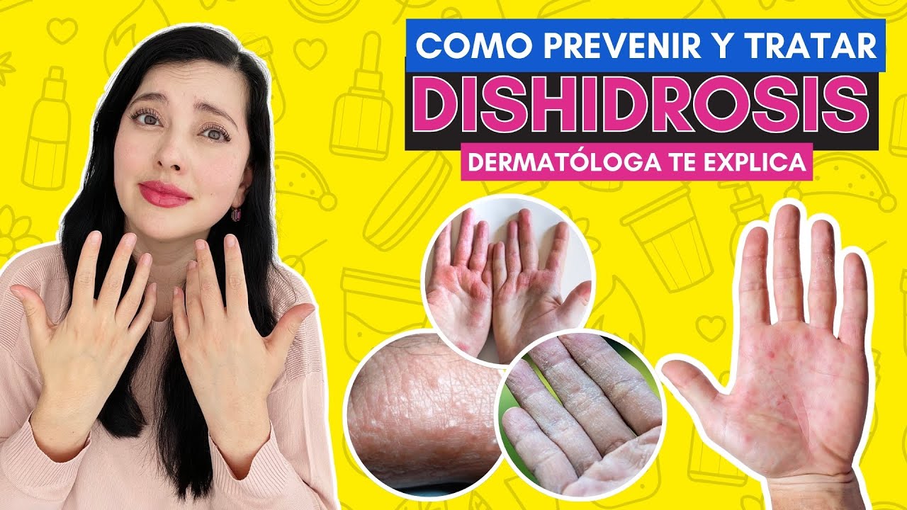 COMO Controlar la DISHIDROSIS 🤔✨👩🏻&zwj;⚕️