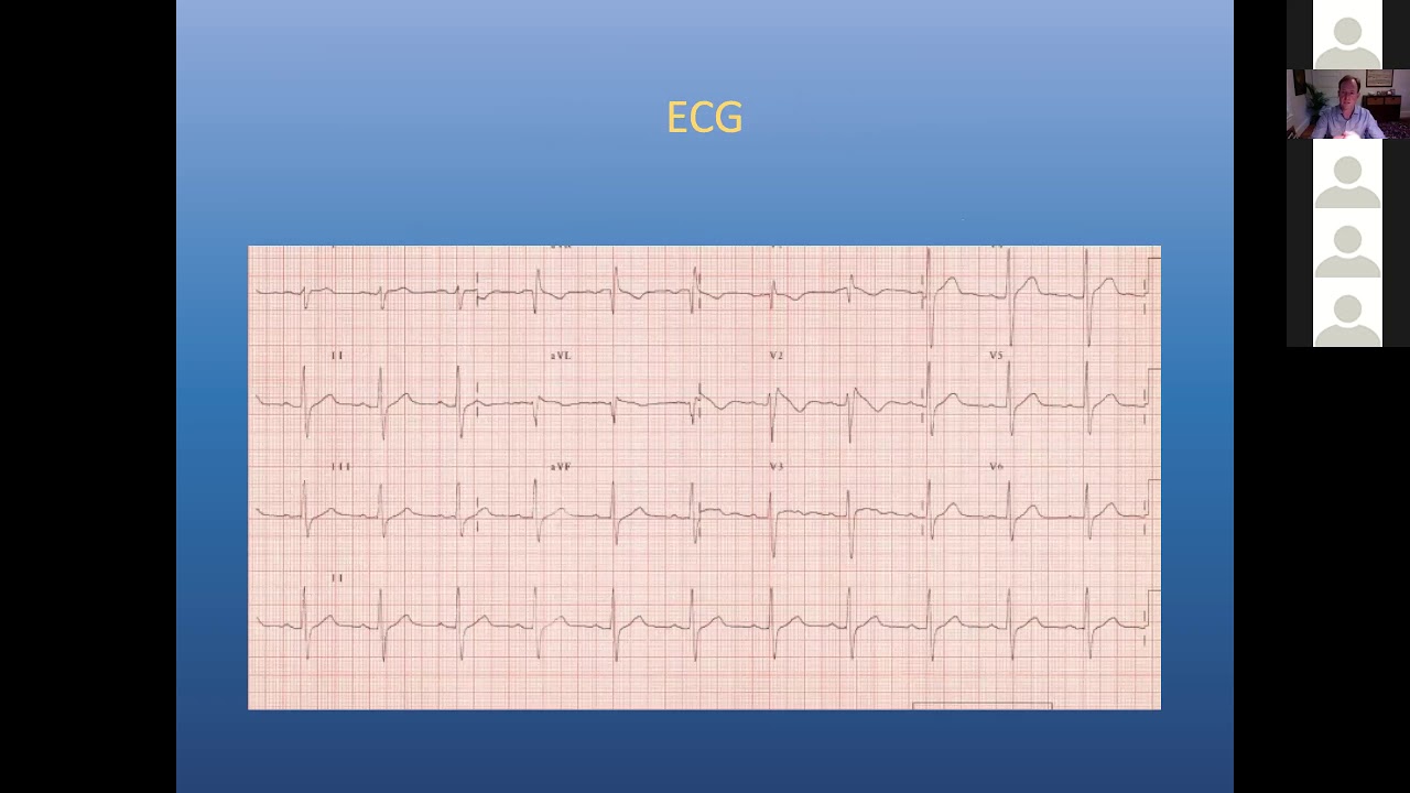 6 24 20 Wylie Brugada Syndrome