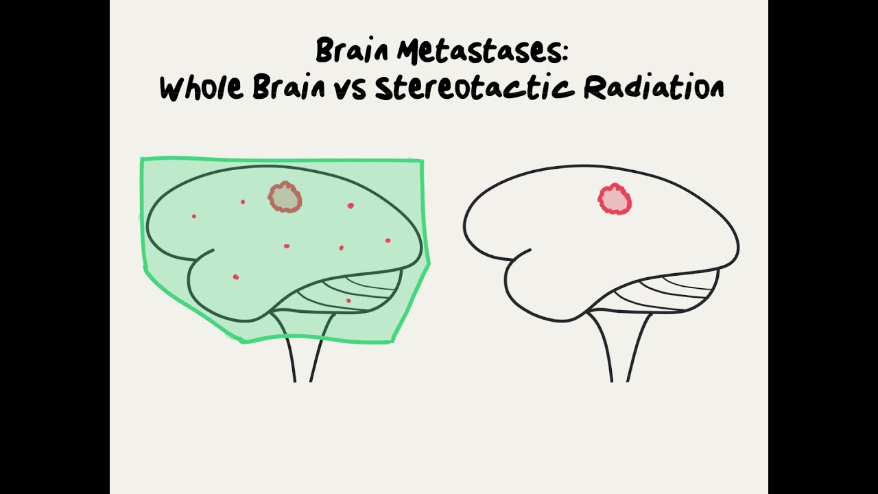 Doctor Explains Whole Brain Radiation versus Stereotactic Radiosurgery for Brain Metastases