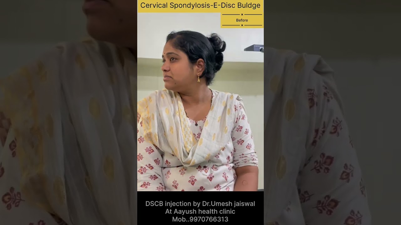 INJECTION DSCB IN CERVICAL SPONDYLOSIS BY DR UMESH JAISWAL AAYUSH CLINIC PUNE MAHARASHTRA 9970766313