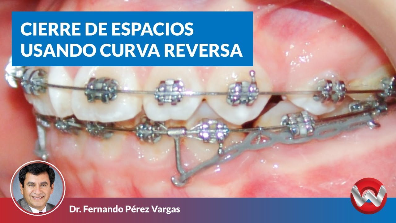 Cierre de espacios usando arco con curva reversa I