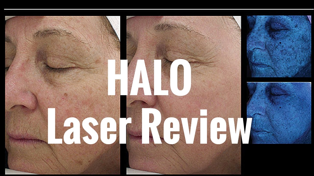 Latest Fractional Laser Resurfacing