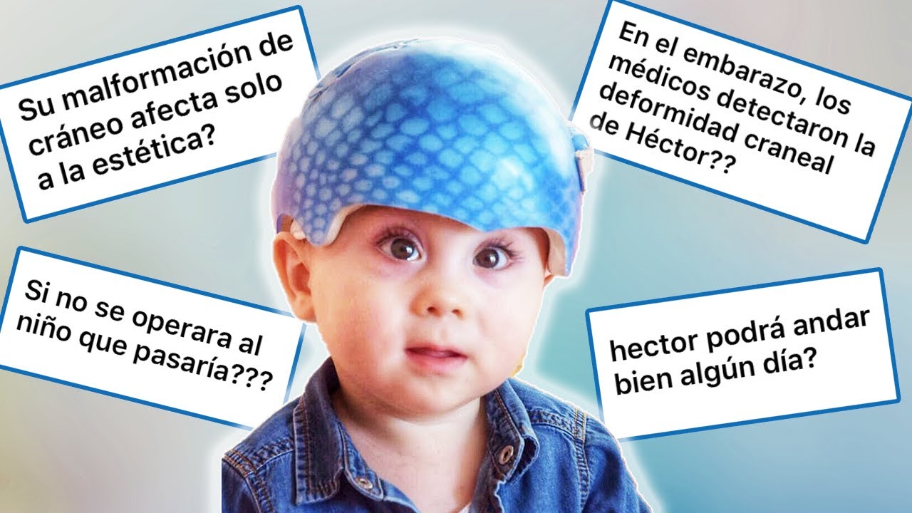 ¿HECTOR PODRA ANDAR? ¿SU DEFORMACION DE CRANEO SE DETECTO EN EL EMBARAZO?