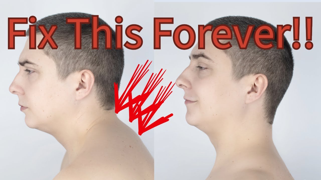Neck hump correction, for good!  #posture #longevity #neckhump
