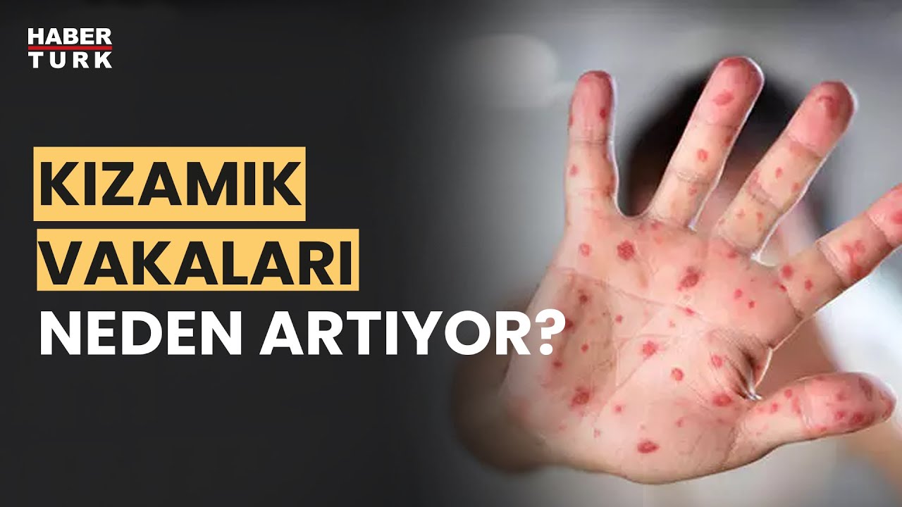 Kızamık salgını tehlikesi var mı? Prof. Dr. Mehmet Ceyhan yanıtladı