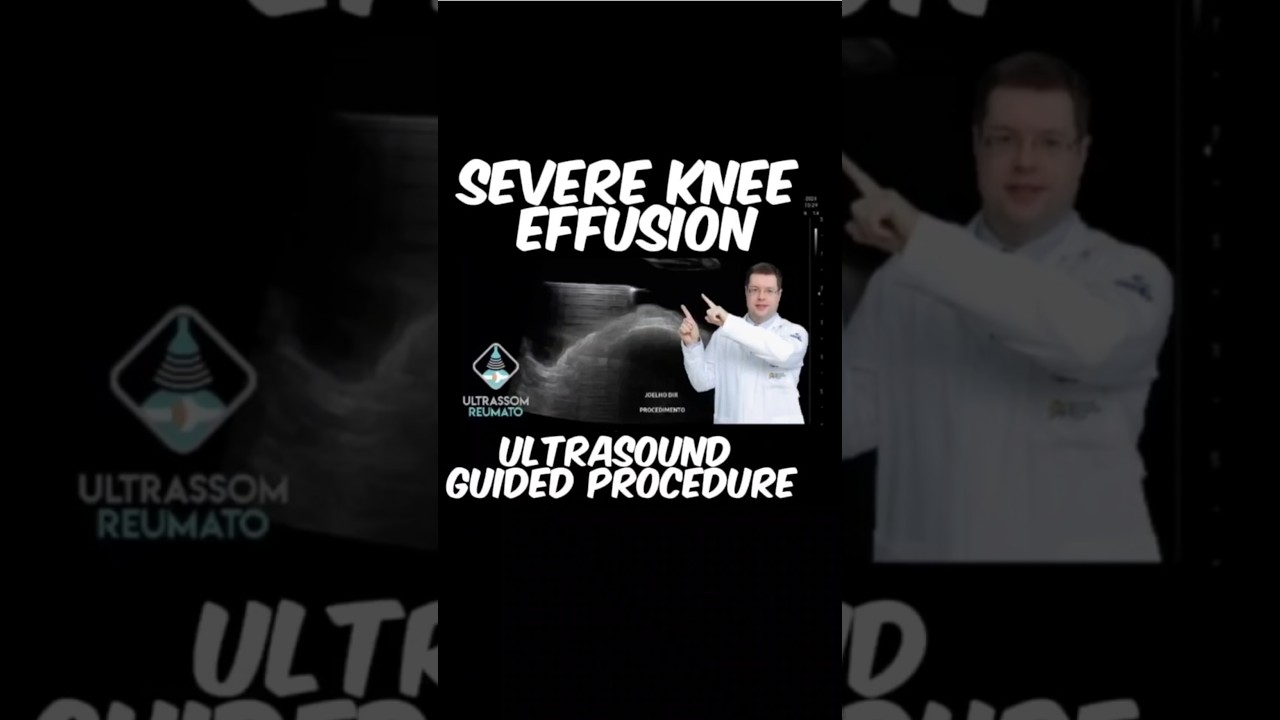 Severe Knee Effusion Ultrasound Guided Procedure