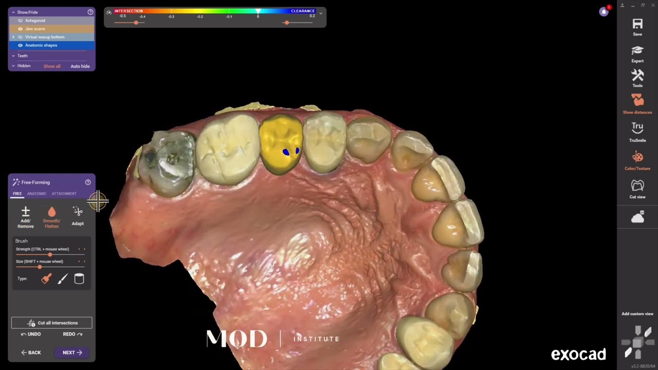 Split file 3D printed partial denture exocad design