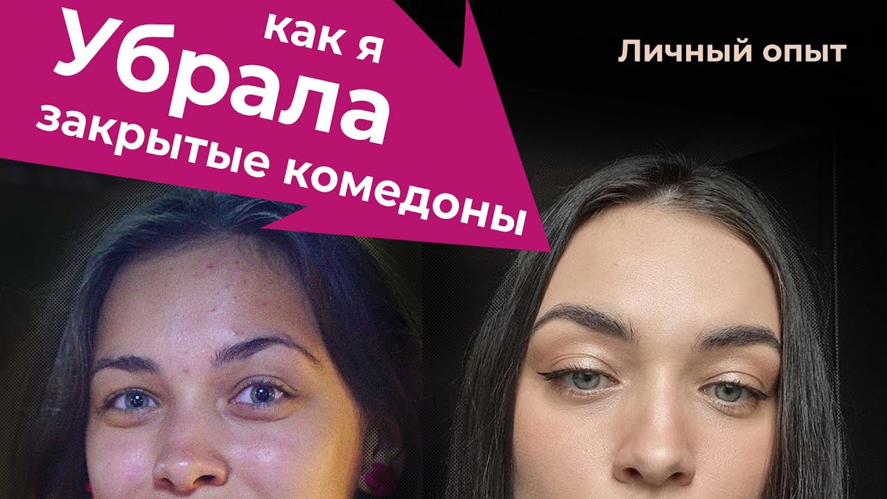 Моя история борьбы с ЗАКРЫТЫМИ КОМЕДОНАМИ И АКНЕ,  лекарства от немецкого дерматолога