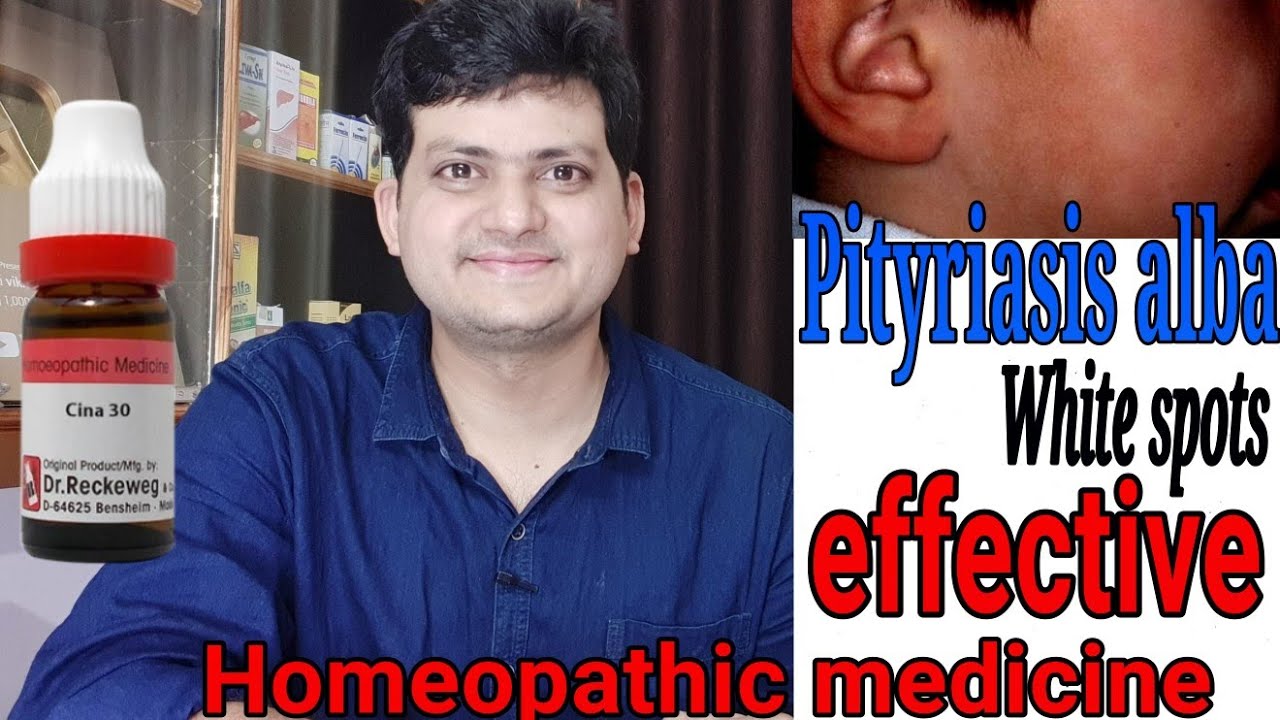 Homeopathic medicine for white spot on face of children ? बच्चों के चेहरे में सफेद दाग !