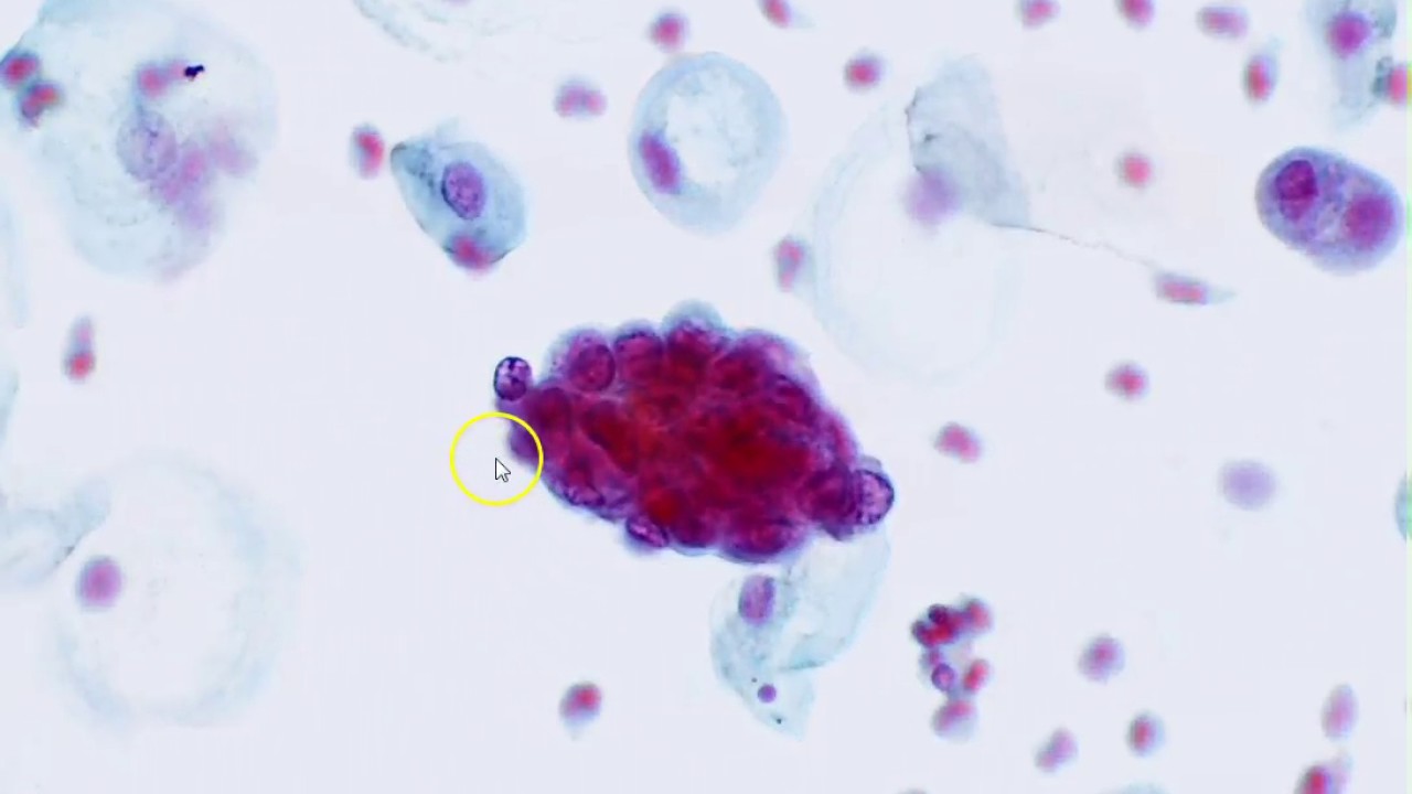 Cervical cytology - Endometrial cells