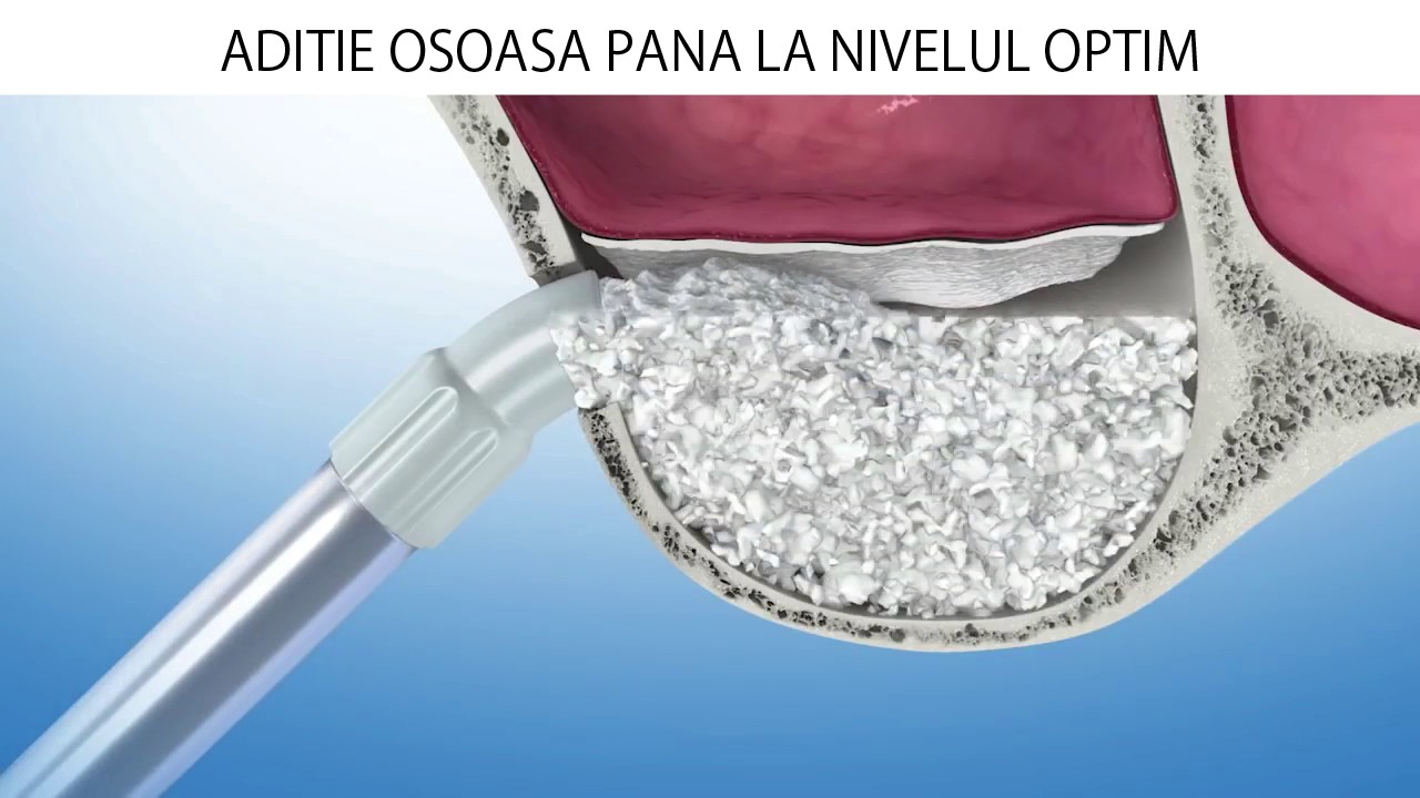 SINUS LIFT