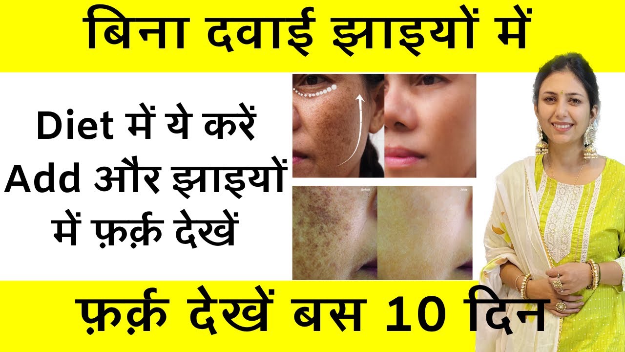 Diet for Pigmentation | Hyperpigmentation Melasma Jhaiyo Ke Liye Best Remedy | Dr. Upasana Vohra