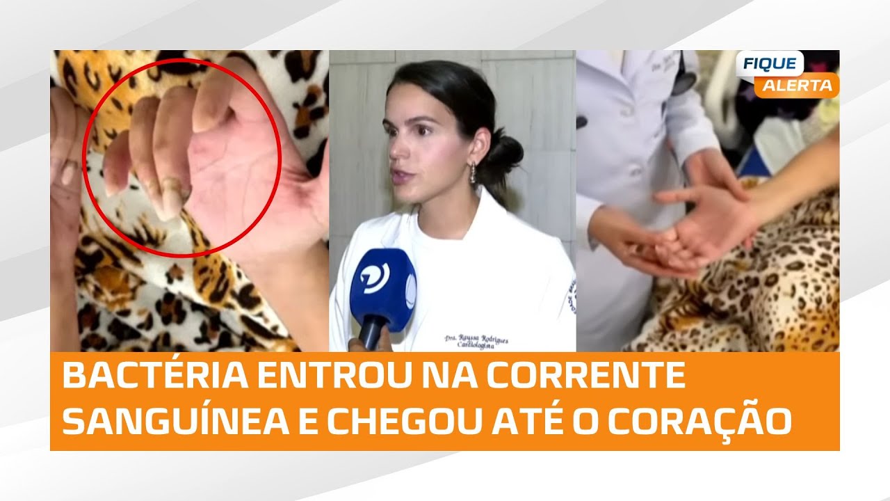 ALERTA: Jovem é diagnosticada com endocardite infecciosa após colocar unhas em gel em Alagoas