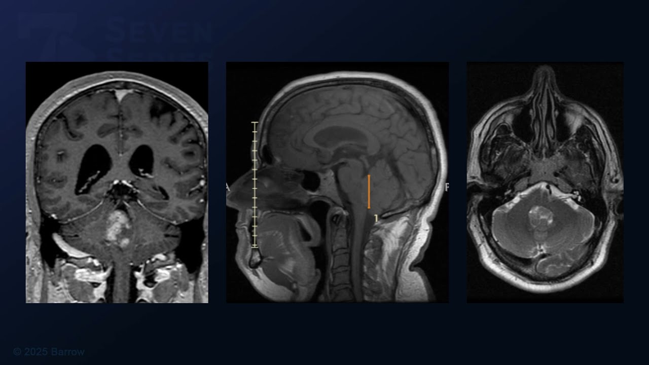 Suboccipital Craniotomy and Telovelar Approach for Fourth Ventricular Ependymoma Resection
