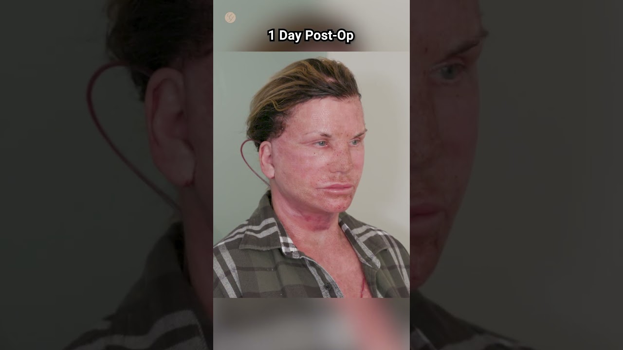 Reversing Time: The Power of Deep Plane Facelifts #deepplanefacelift