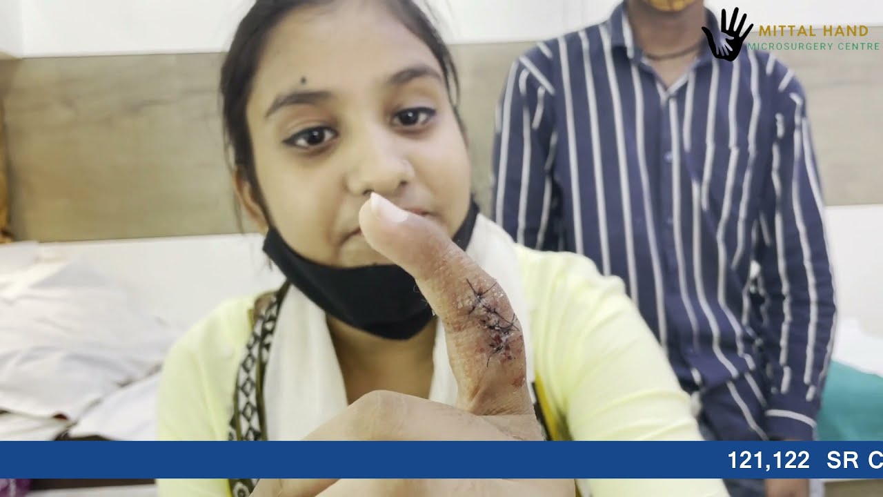 Finger Damaged in accident Reconstructed Again - Next Level Hand Surgery in (jaipur) India