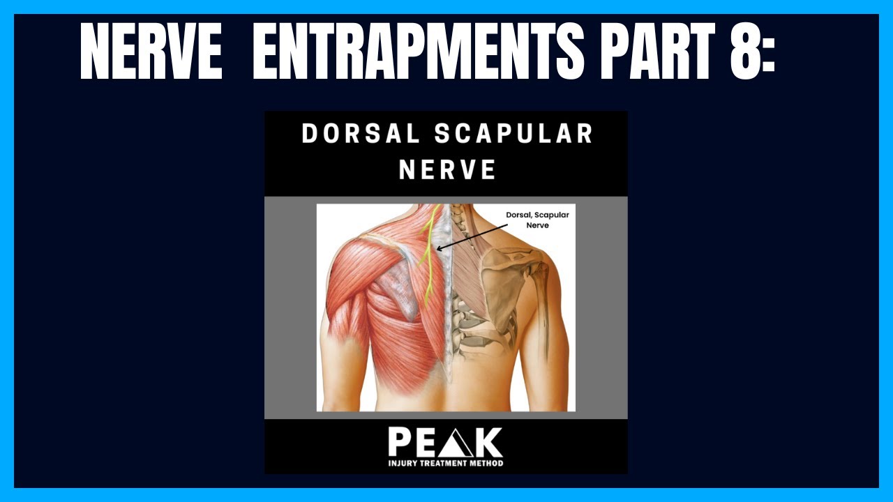 Nerve Entrapments Part 8: Dorsal Scapular Nerve