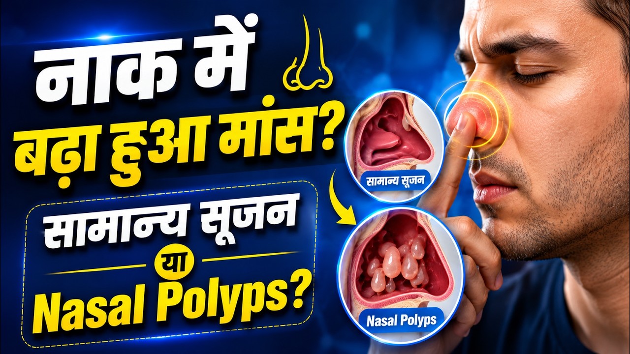 Nasal Polyps (नाक के बढे हुए मांस) का इलाज कैसे करे, Naak me Maas ka Badhna, Nasal Polyps Treatment