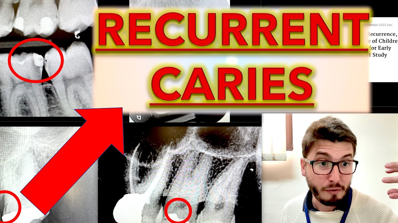 Recurrent CARIES for BEGINNERS: Decay on Dental X-Ray, Cavity teeth Removal (ICDAS, Radiographs)