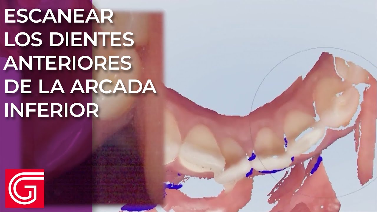 Cómo escanear los dientes anteriores de la arcada inferior correctamente