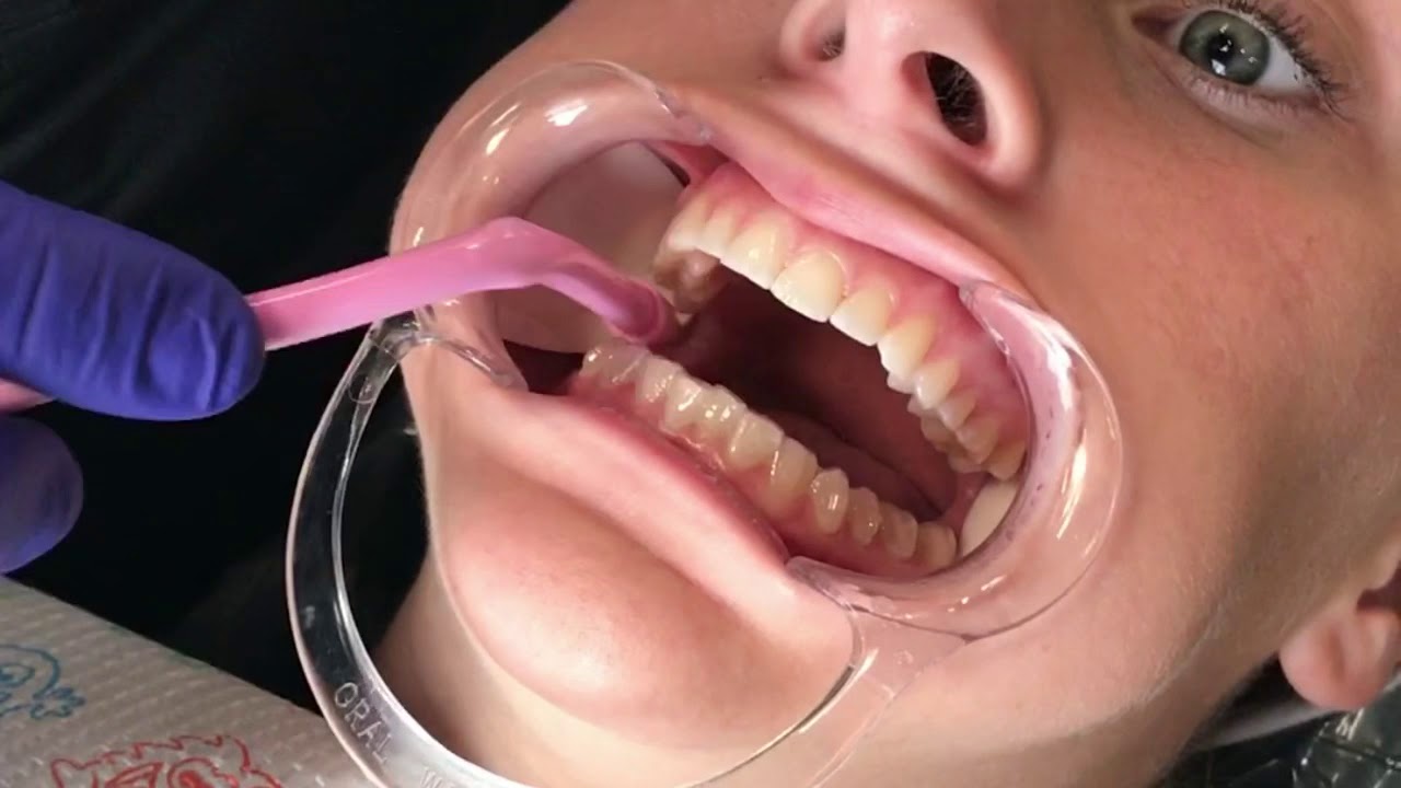 Bonding Invisalign Attachments