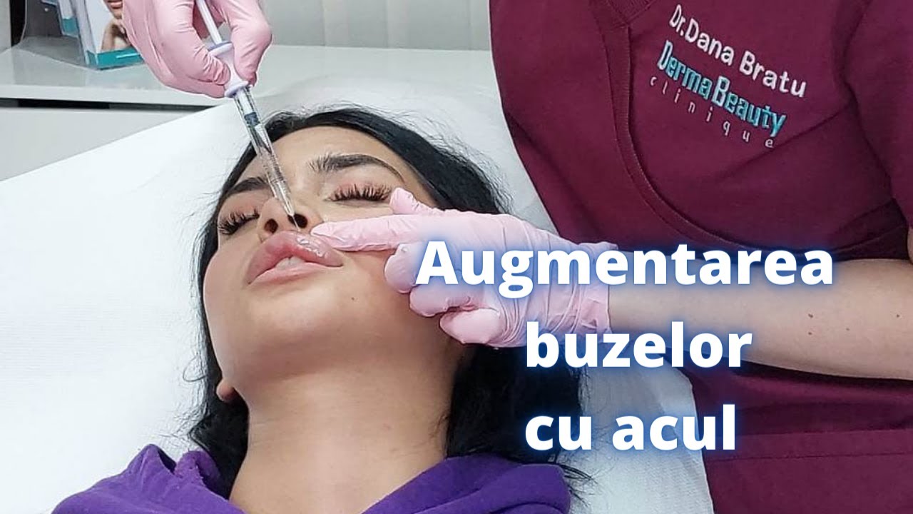 Volumizarea buzelor prin intermediul acului | DermaBeauty Clinique