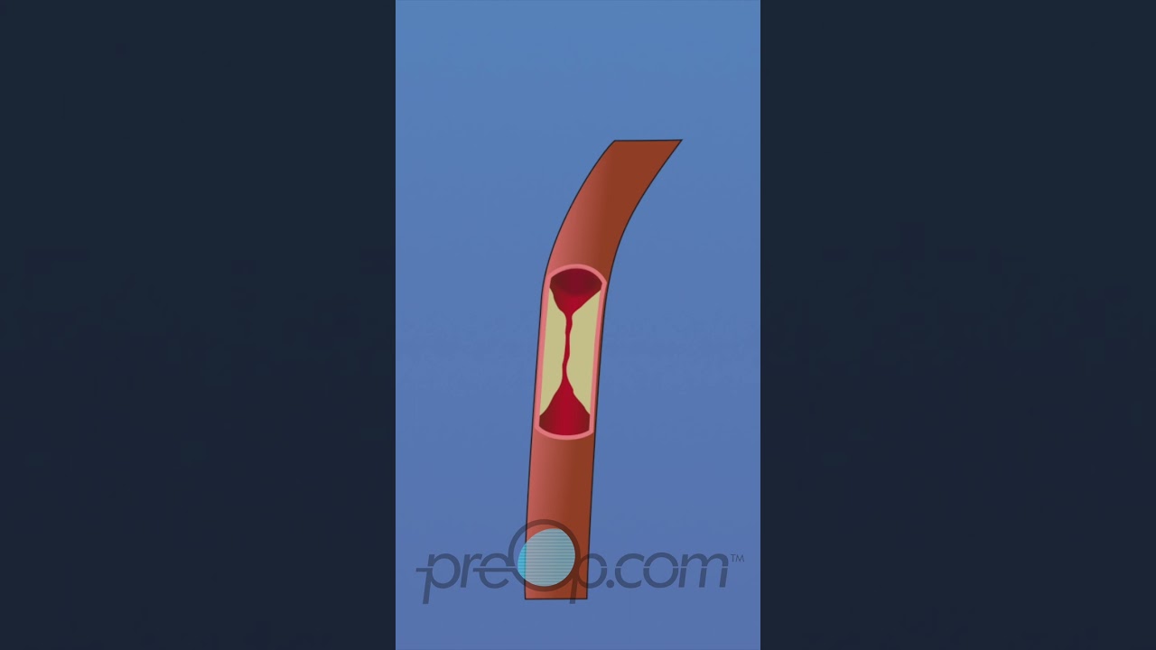 Heart Bypass Surgery Explained 🚑: CABG Off-Pump | #shorts #preop #HeartHealth | PreOp® Patient Edu