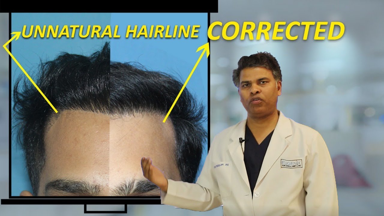 Unnatural Hairline in Hair Transplant and Aesthetics| @EugenixHairSciencesofficial By- Dr. Pradeep Sethi