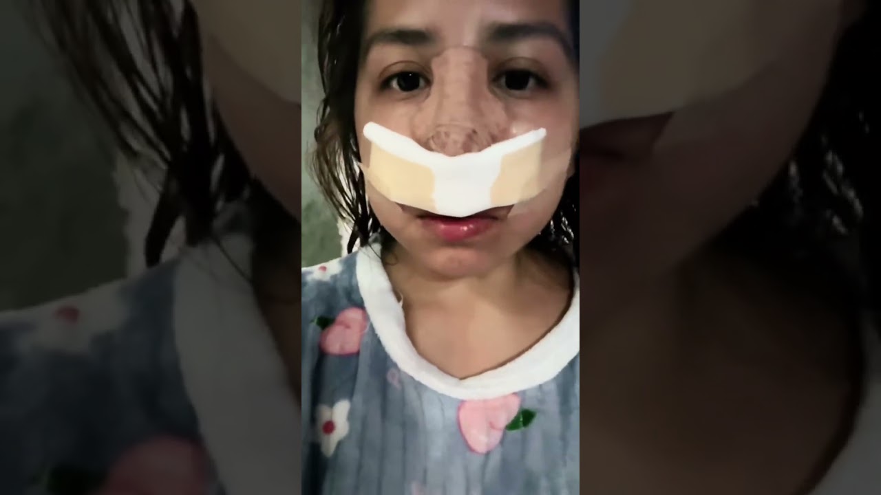 RINOPLASTIAAAAAAA tenia estos videos guardados !  #rinoplasty #viral #cirugiaplastica 