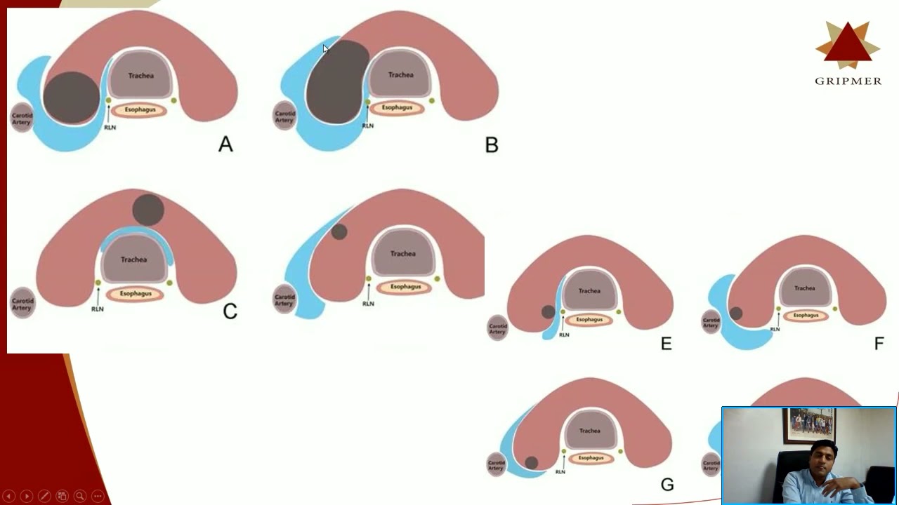 Dr. Ajit Kumar Yadav:  MWA of Benign Thyroid Nodule: Technique and Results