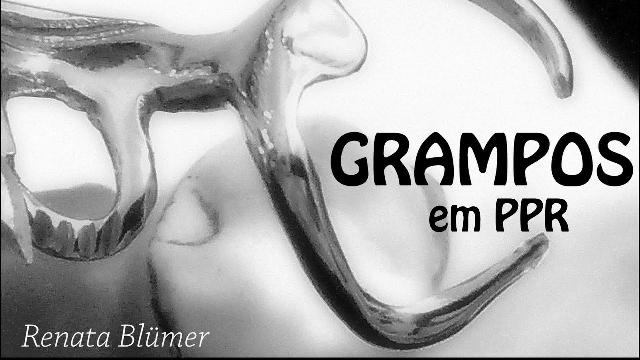 🔺GRAMPOS EM PPR  #gramposemppr #componentesdappr #proteseparcialremovivel #cursoppr #planejamentoppr