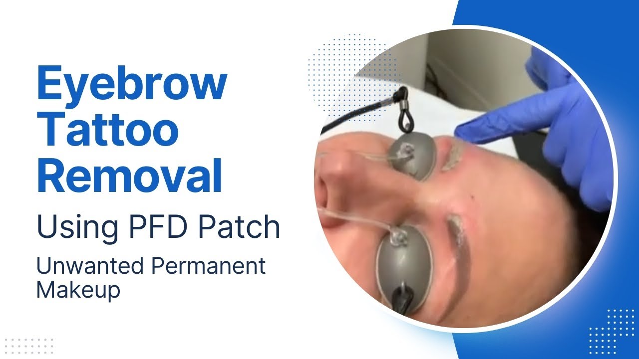Eyebrow Tattoo Removal | Using PFD Patch | Unwanted Permanent Makeup | Dr. Jason Emer