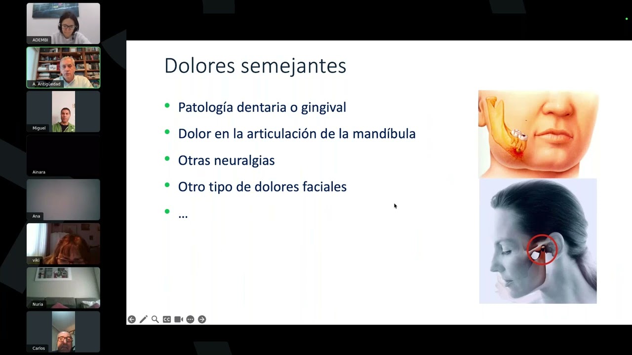 Neuralgia del trigemino