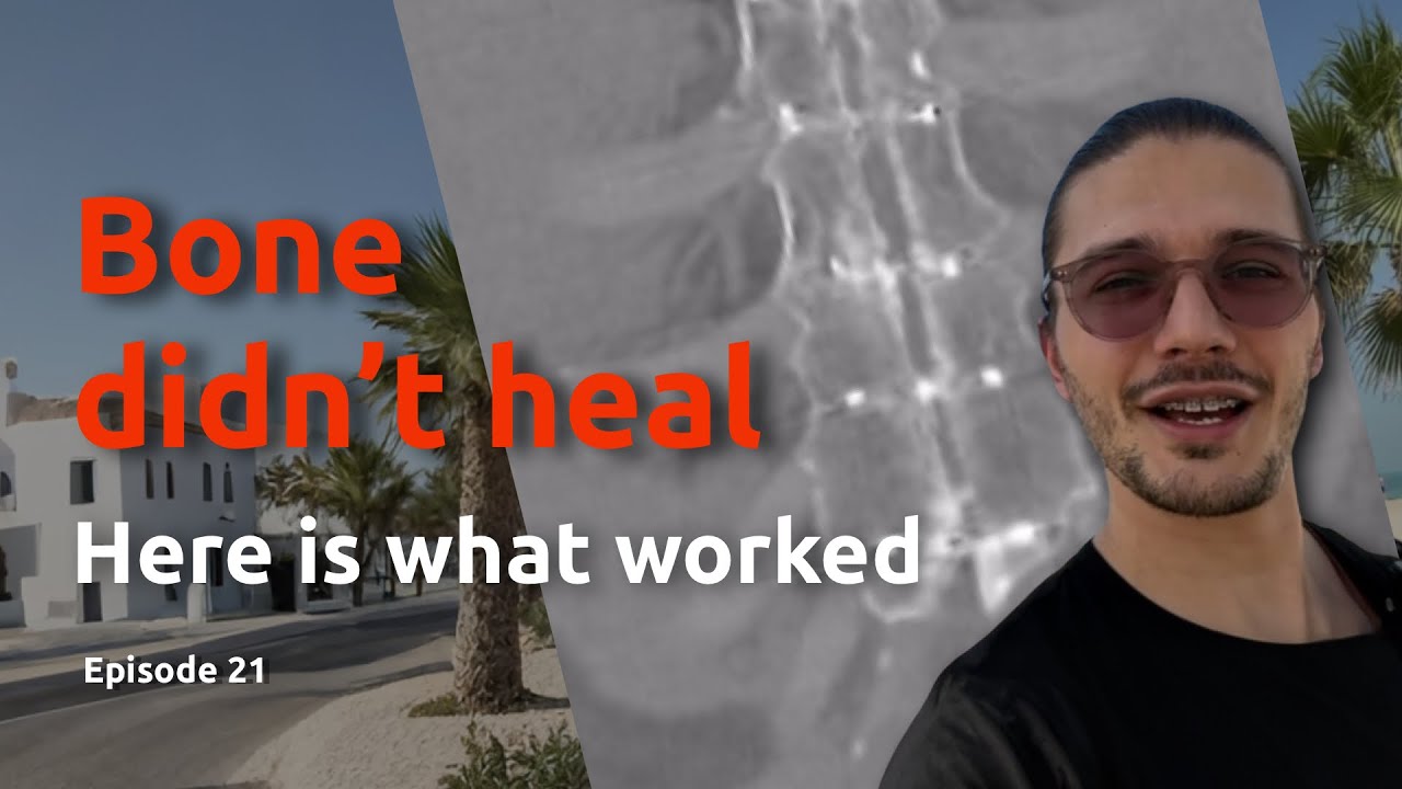 My Sternum Didn&rsquo;t Heal After Open-Heart Surgery &mdash; How I Finally Fixed It