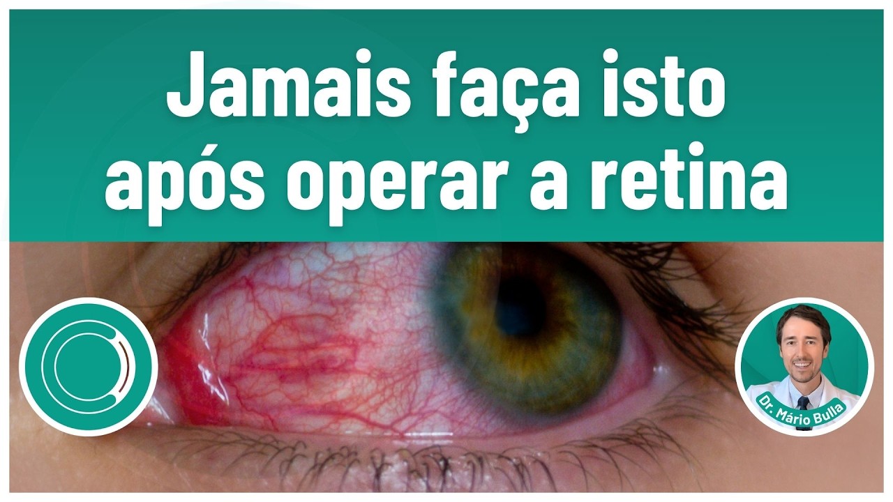 Pós-operatório de cirurgia de retina: 5 coisas proibidas!